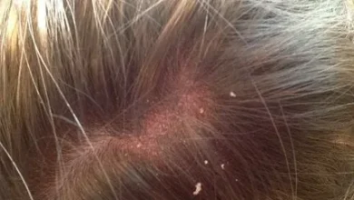 الصدفية في الشعر